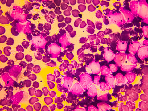 Multiple Myeloma Awareness: Bone marrow aspirate cytology of multiple myeloma, a type of bone marrow cancer of malignant plasma cells.