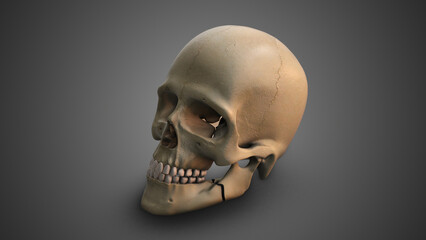 A skull with Broken Jaw