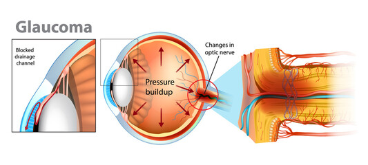 Glaucoma is a group of eye diseases that lead to damage of the optic nerve. Intraocular pressure in the back of the eye