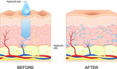 Hyaluronic acid. Skin rejuvenation