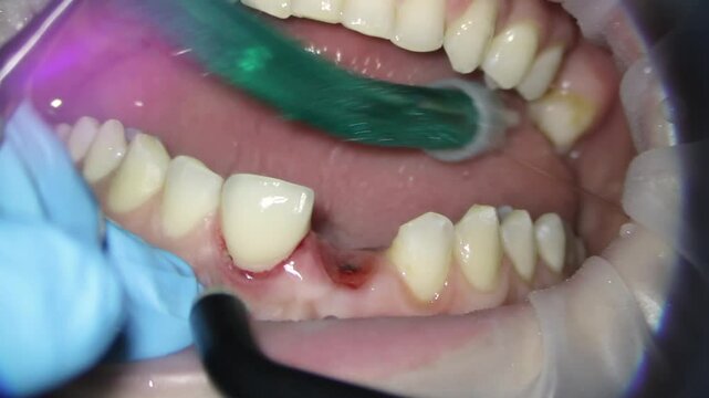 dentistry. removal of excess cement after fixation of ceramic restoration, veneer, crown. High quality FullHD footage