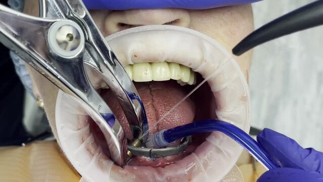 dentistry. preparation for immediate loading of the jaw. intraoral welding of cobalt-chromium alloy beams in the patient's oral cavity