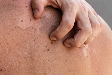 Close-up of a male back with peeling skin due to sunburn