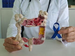 A doctor holds a model of the colon and a blue ribbon, explaining colon cancer awareness concept