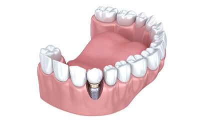 Fototapeta premium Aesthetic Dental Implant in Lower Jaw with Healthy Pink Gums and White Teeth 