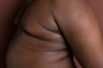 gynecomastia in a brown skin man, a dark skin man with enlarged breast tissue, closeup of man boobs...