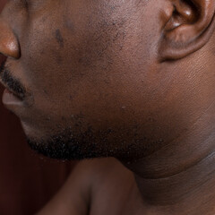 Naklejka premium Brown skin with dark spots, hyperpigmentation on brown skin, african american man with skin blemishes, imperfect skin