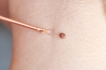 Woman examing her abnormal mole. Dermatology procedure. Doctor checking patient skin cancer...