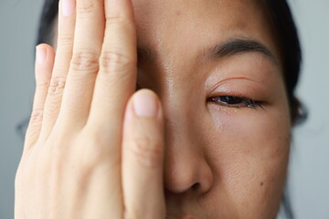 Woman's eyes become inflamed after rubbing her eyes violently. Insects entering eye cause...