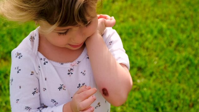 The child has a wound on his arm. Selective focus.