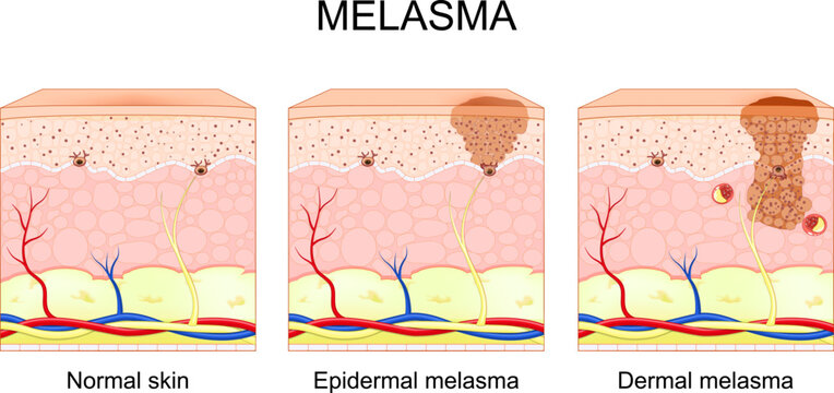 Melasma Types. chloasma faciei. Cross section of human skin with Hyperpigmentation.