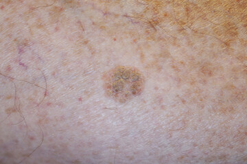 Close-up of a skin with many moles and one dysplastic nevus or atypical mole. This is a mole larger...