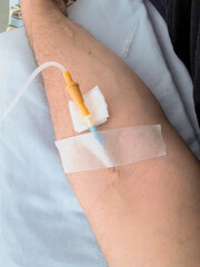 Close-up of a patient's arm with an IV on a hospital bed. The patient's hand, a needle with saline solution in the patient's hand during treatment in the hospital. The patient's arm with an IV.
