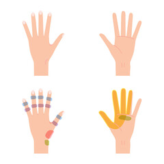 女性の更年期障害：手のこわばり・痛み・しびれの図（手のひらと手の甲）