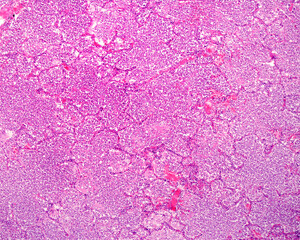 Human lung. Acute pneumonia