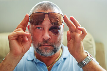 eye injury, man use sunglasses with black eye. man after accident or fight with bruise