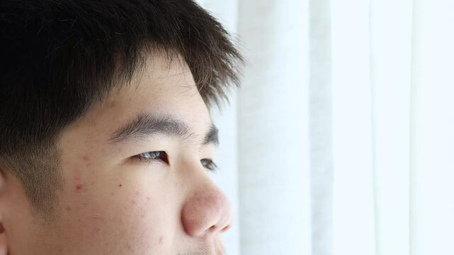 Close-up Asian teenager's face showing visible acne and a focused expression, skin adolescence with male hormone looking camera, illustrating teenage skin care, dermatology, and adolescent health
