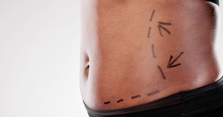 Precision in Practice: A Surgeon's Expertise in Drawing Correction Lines