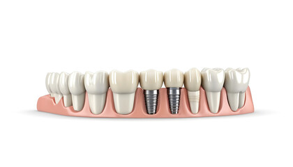 White dental implant. Dental implant. Implants can support a permanent single tooth crown, a multi-tooth bridge or even a full fixed denture. Generative AI