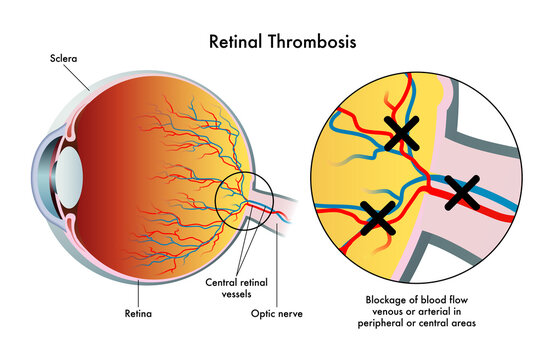 Medical illustration shows the consequences of retinal thrombosis.