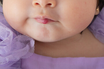 Hemangioma benign tumor on Little newborn tiny human baby on the lip