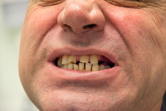 Close-up of a male patient's mouth showing damaged teeth BEFORE dentures. The man is missing some teeth and his teeth are very worn. Real photo from the series. There are before and after photos.
