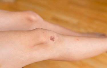 Fresh wound and blood from injured on child knee after she has been an accident