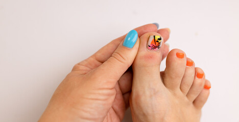 A woman shows a blister on her big toe