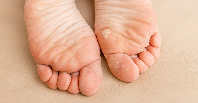 Close up of woman legs with callus on it