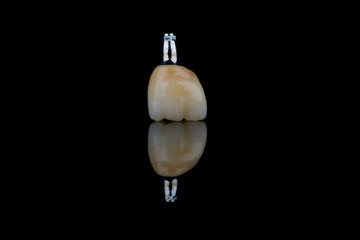 Single dental crown of molar with individual titanium abutment for fixation on implant.