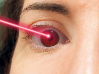 Close-up of brown eye treated with LASIK or LASEK red laser beam surgery process for vision...