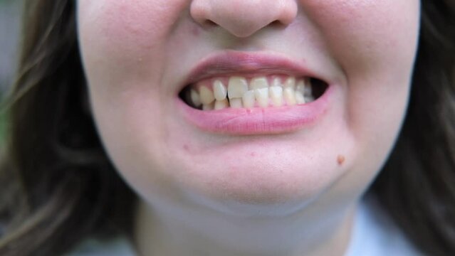 close up of a woman smiling teeth, jaw with malocclusion 