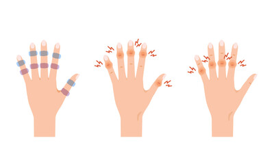 女性の更年期障害：へバーデン結節・ブシャール結節のセット（指の関節の痛み・腫れ・変形）