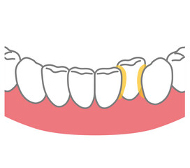 歯と歯が重なったところに溜まった歯垢　歯磨き　磨き残し