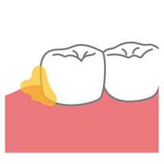 奥歯の後ろに溜まった歯垢　歯磨き　磨き残し
