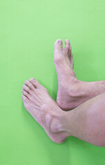 Elderly feet Toe nails suffering from fungal infection Dry feet, skin care problems health care medical concept and healthy feet and skin on a green background
