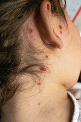 Child with chickenpox spots, childhood illness caused by the varicella zoster virus