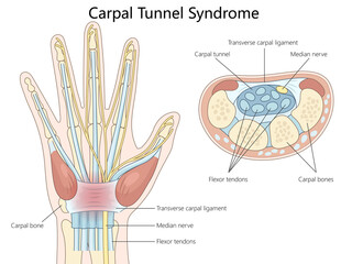 anatomy of carpal tunnel syndrome, highlighting the median nerve, flexor tendons, and carpal bones diagram hand drawn schematic raster illustration. Medical science educational illustration