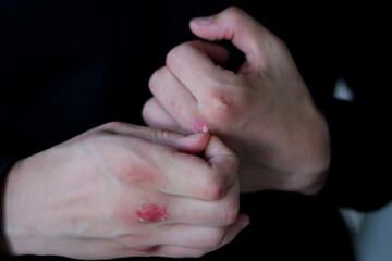 boxer with broken hands bleeding puts on a black shirt. Handsome man with black hair and blue eyes. Mixed race nationality. Close up boxing trainer or manager wrapping hands of a boxer reparing