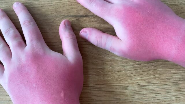 Burnt reddened skin on the hand of a man with sunburn. Skin care and protection from the sun's ultraviolet rays.