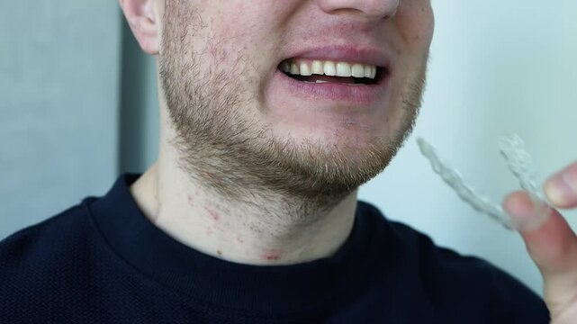Jaw alignment for a beautiful smile. Place the aligner on your teeth. A man with a mouthguard in his teeth. Transparent protector for teeth against broken fillings.