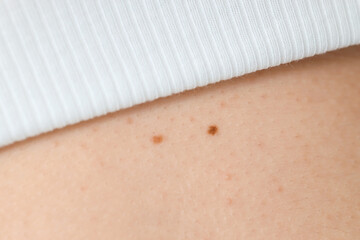 Human skin with different moles, closeup