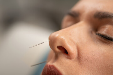 Facial paralysis treatment with acupuncture