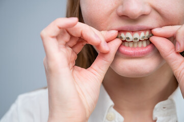 Close-up portrait of a red-haired girl touching braces. Young woman corrects bite with orthodontic appliance.