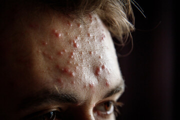 Chickenpox virus rash on the forehead of an adult.