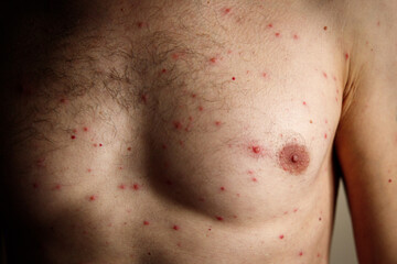 Fototapeta premium Close-up a man torso front who having varicella blisters or chickenpox or Monkeypox. New virus dangerous over the world.