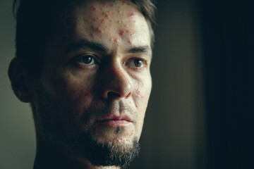 Fototapeta premium Portrait of an adult man with a rash on his face in the form of red dots, this is what symptoms of any smallpox look like, for example chickenpox.