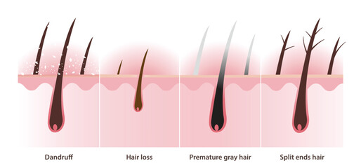 The cross section of hair problems with scalp layer vector illustration on white background. Dandruff, white dry flaky, scaly scalp, hair loss, alopecia, premature gray hair and split ends hair.