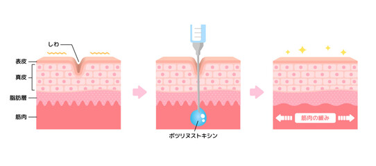 ボトックス注射 (ボツリヌストキシン）によるシワ取りのメカニズム / ベクター図解イラスト