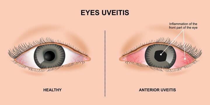 Uveitis Eyes Inflammation Illustration realistic